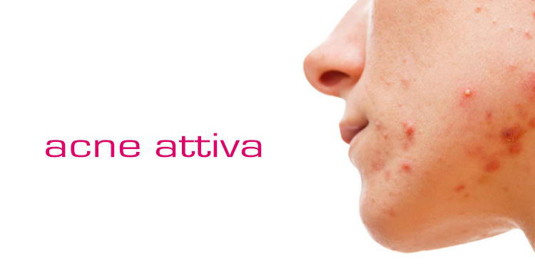 Acne attiva, sedute Laser