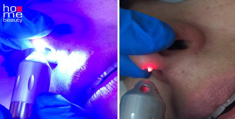 trattamento angiomi e nevi con laser blue