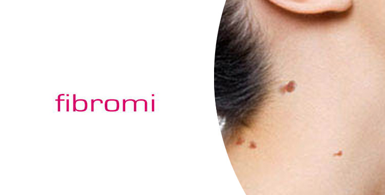 trattamento laser blue contro il dermo-fibroma